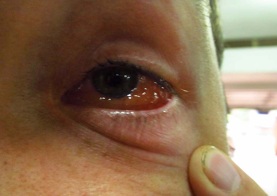 Těžko říct, zda to bylo divokou jízdou (a pádem) na motorce, spaním na autobusových nádražích, jídlem nebo jen podnebím, ale mé oko nejprve zoranžovělo a pak začalo opouštět hlavu. Lékař uměl jen laosky, ale vysvětlil mně, že thymosis to není (sic!) a prodal mi léky, které po několika dnech pomohli mně i Drobkovi, která se mezitím nakazila ode mě.